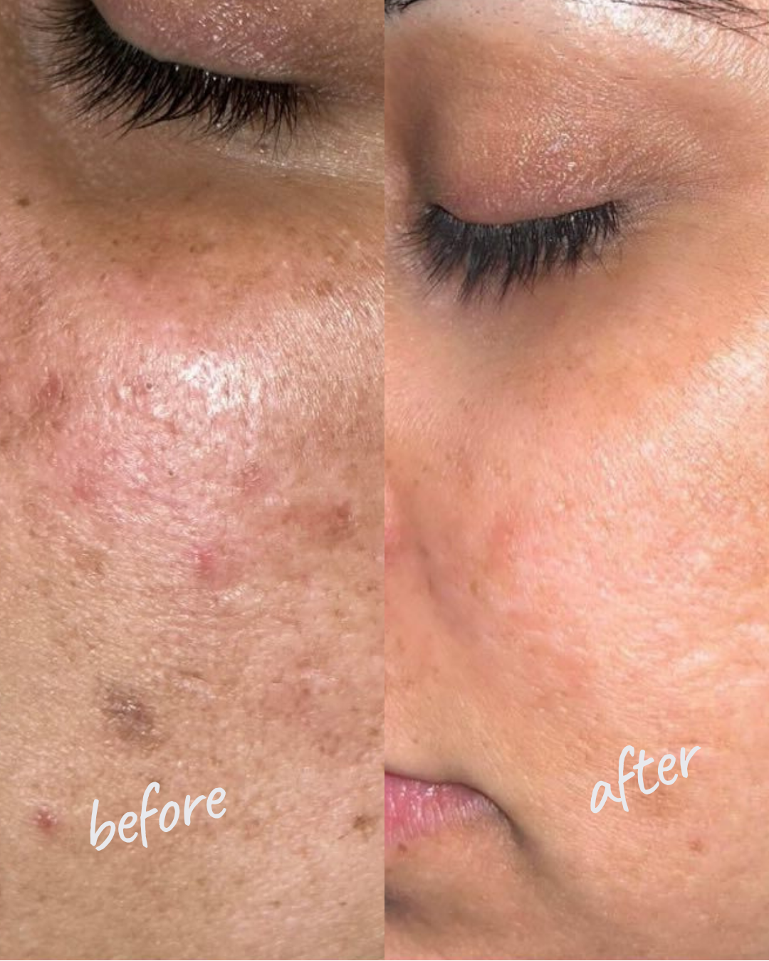 PRP Hair Restoration — Hair Growth Result NYC